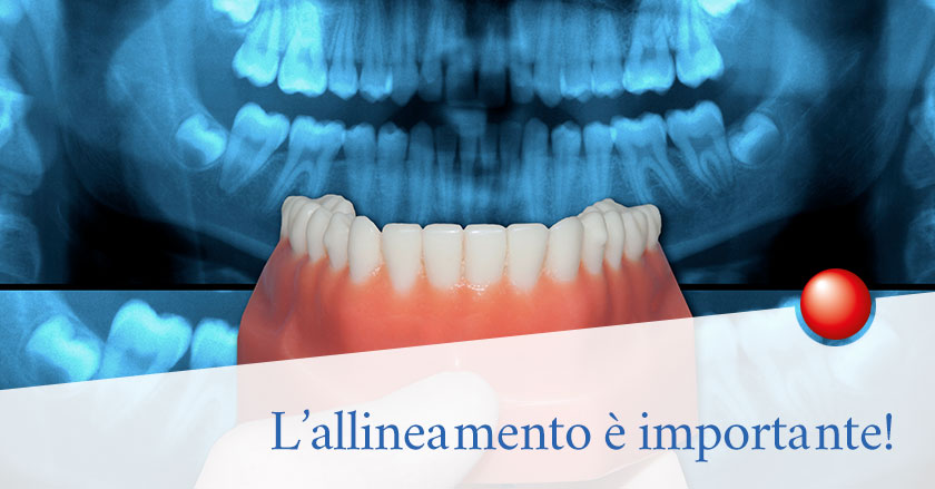 Cos’è la Malocclusione e come si risolve
